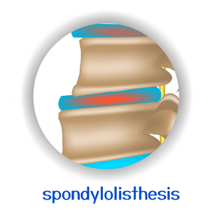 image of Manahawkin spondylolisthesis